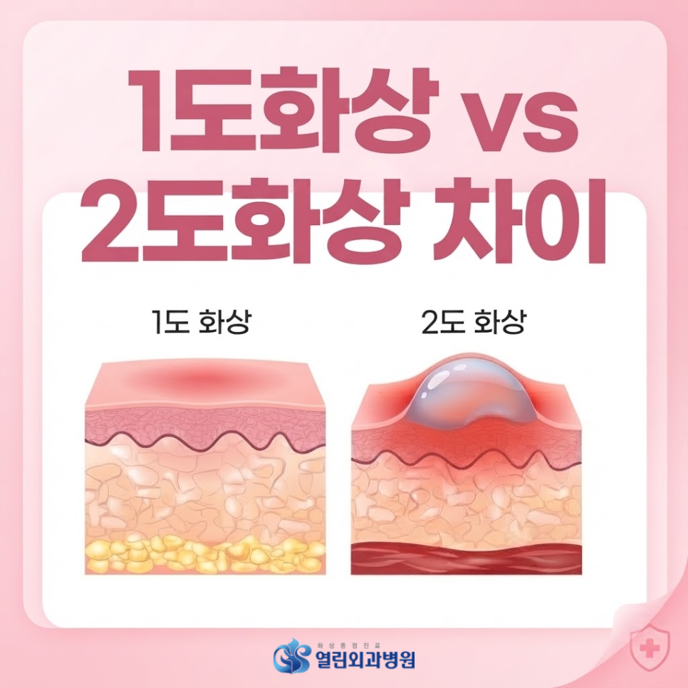 1도화상 2도화상 차이, 물집 유무로 구분하는 3가지 포인트