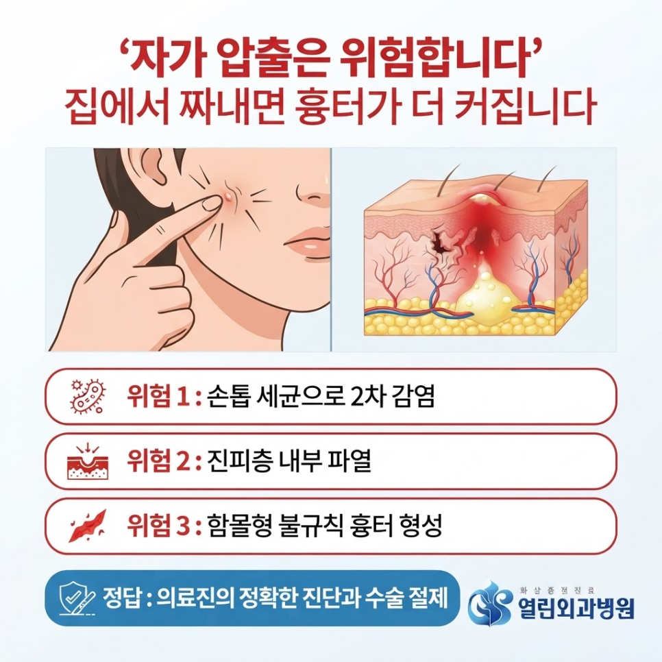 안산피지낭종 관련 이미지 8